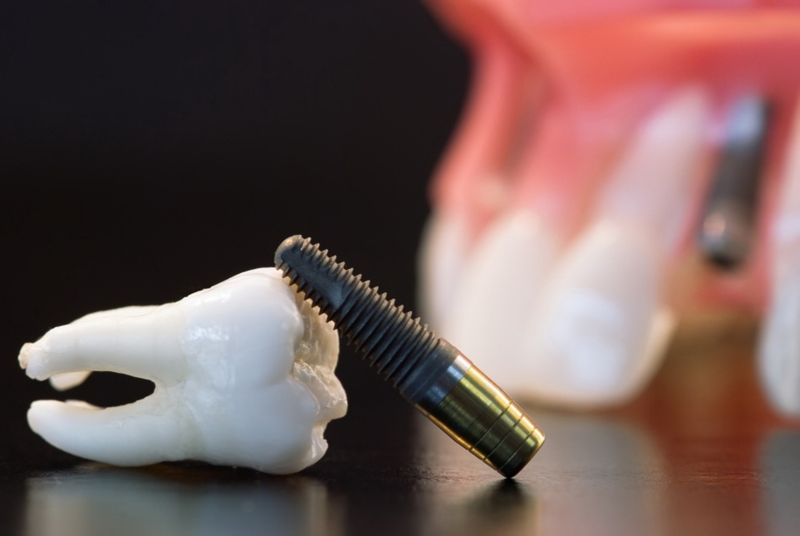 Dental_Implants05