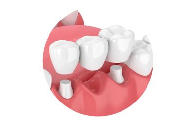 Fixed-Prosthodontics